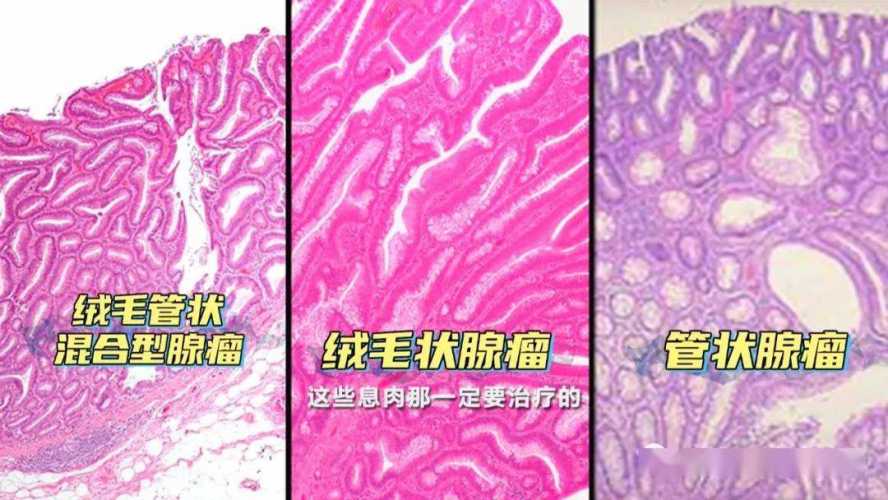 产后侧切口长息肉有图片吗-第1张图片