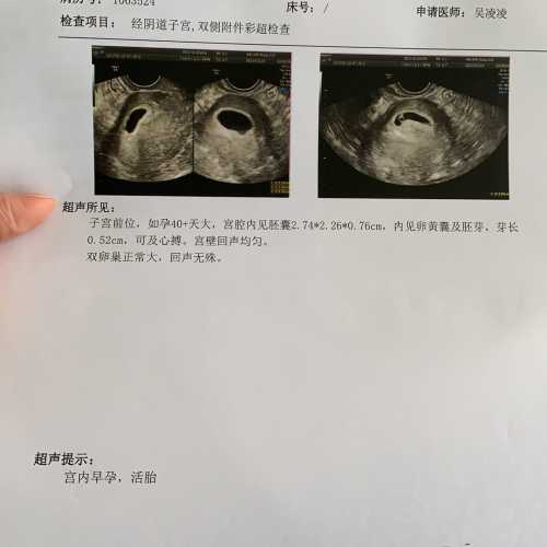 孕5周突然孕反消失正常吗-第1张图片