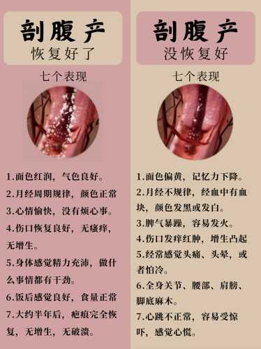 剖腹产伤口左边牵扯疼咋回事-第1张图片