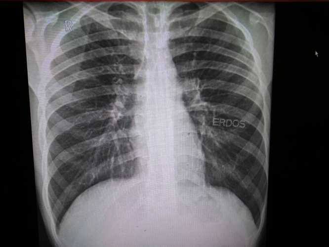 婴儿胸片辐射大吗-第1张图片