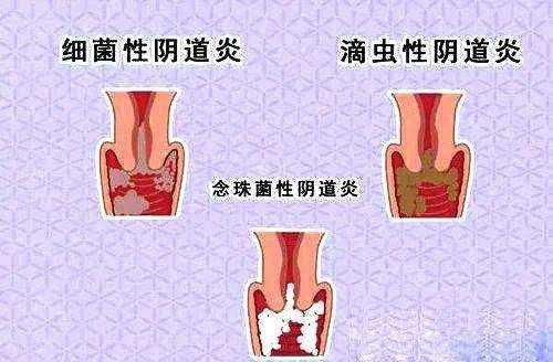 滴虫性阴道炎能正常怀孕吗-第1张图片