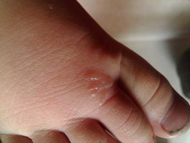 新生儿脚底发紫咋回事-第1张图片