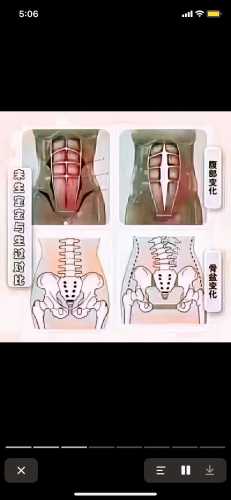 剖腹产能做平板支撑吗-第1张图片