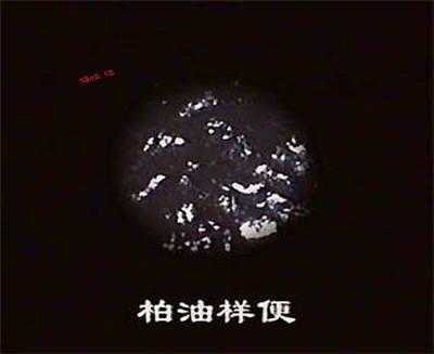 顺产后拉黑色大便正常吗-第1张图片