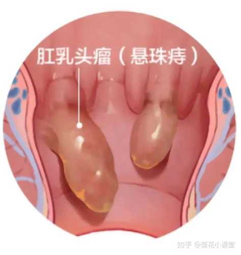 产后肛门有小肉球该咋办-第1张图片