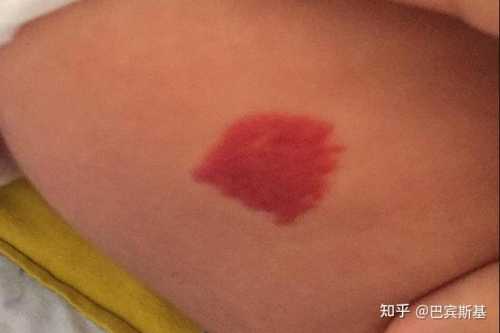 新生儿脸上有红色胎记怎么办-第1张图片