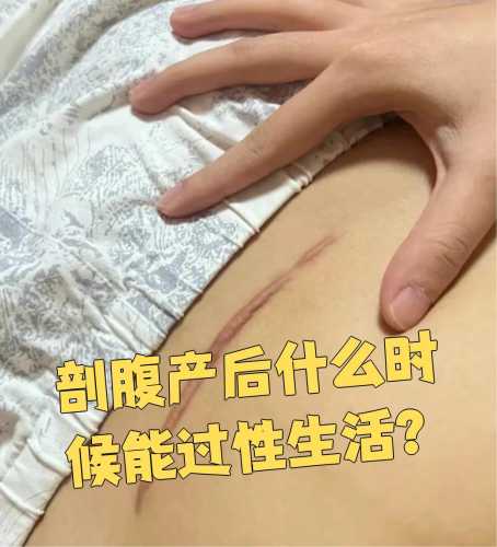 剖腹产多久能顺产-第1张图片