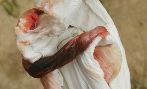 怀孕11周能打胎吗-第1张图片