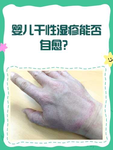 新生儿湿疹能自愈吗-第1张图片
