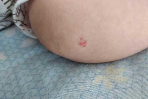 为什么新生儿会有血管瘤-第1张图片