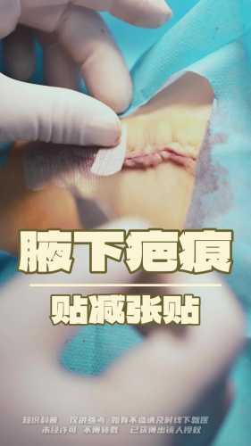 剖腹产刀疤减张贴有用吗-第1张图片