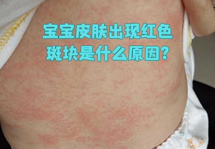 新生儿湿疹有什么症状表现-第1张图片