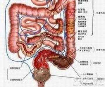 结肠炎治疗多久能备孕-第1张图片