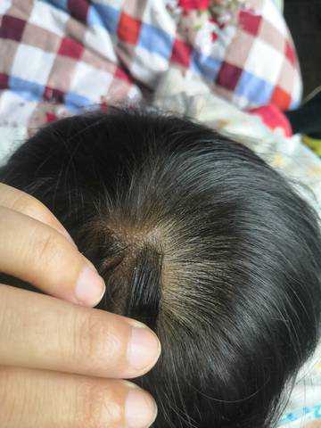 哪里能找到婴儿头皮屑图片-第1张图片