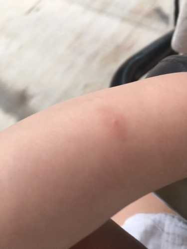 婴儿身上长小疙瘩怎么办-第1张图片