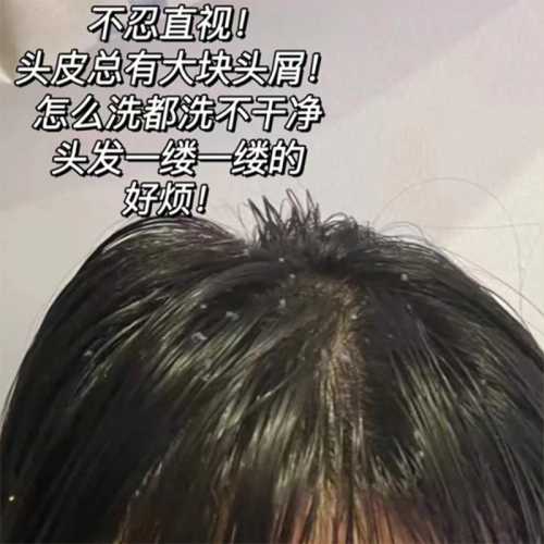 产后头发变油是什么原因-第1张图片