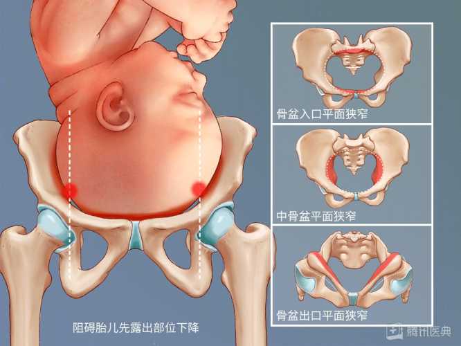 剖腹产和阴道分娩有何不同-第1张图片