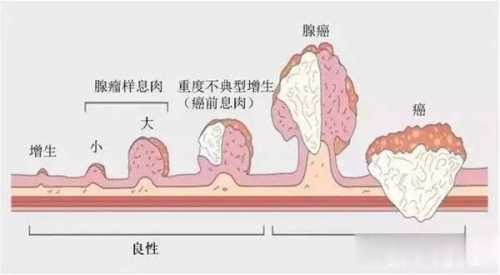 产后阴道口息肉怎么办-第1张图片