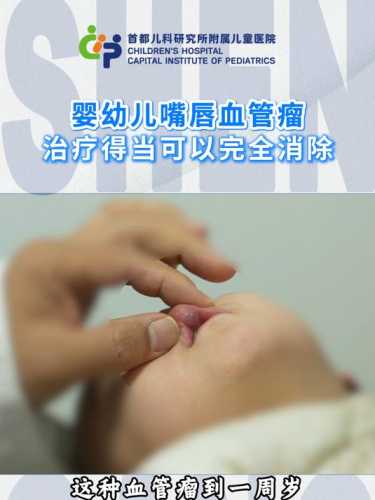 婴儿血管瘤怎么治疗-第1张图片