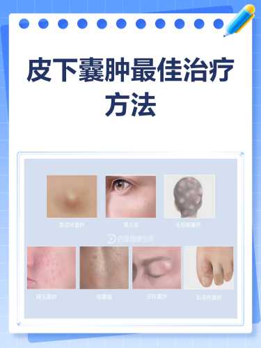 产后有囊肿该怎么办-第1张图片