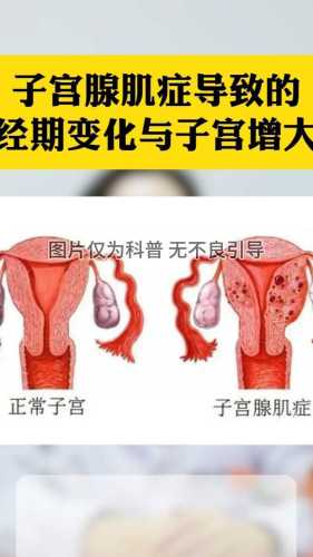 腺肌症经期延迟如何备孕-第1张图片