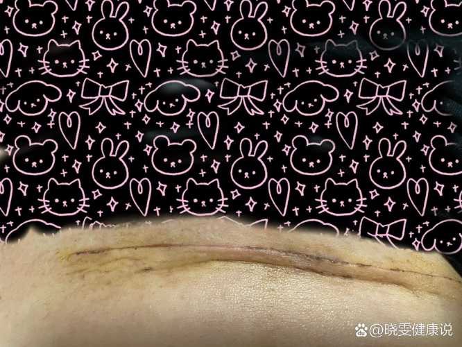 剖腹产刀口上面有硬块是怎么回事-第1张图片