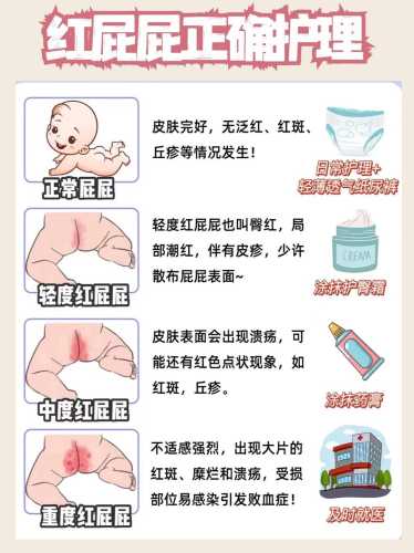 吉氏尿不湿会红屁屁吗-第1张图片