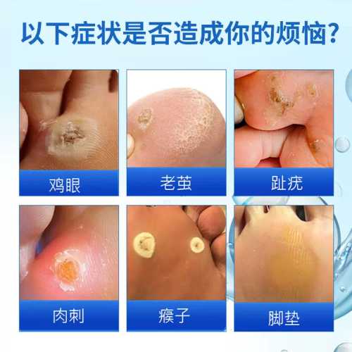 备孕能用鸡眼膏吗-第1张图片