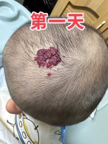新生儿血管瘤因何而生-第1张图片