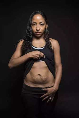 剖腹产一年后刀口为何会痒-第1张图片