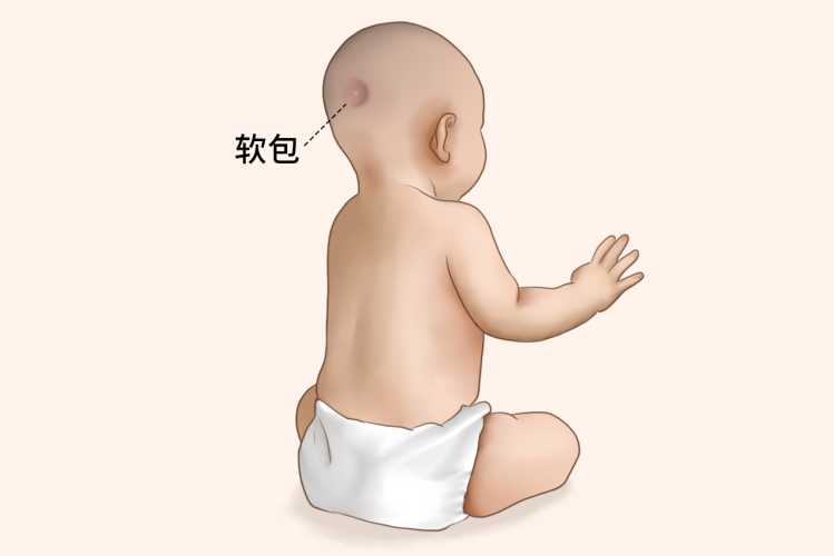 新生儿头上长包怎么办-第1张图片