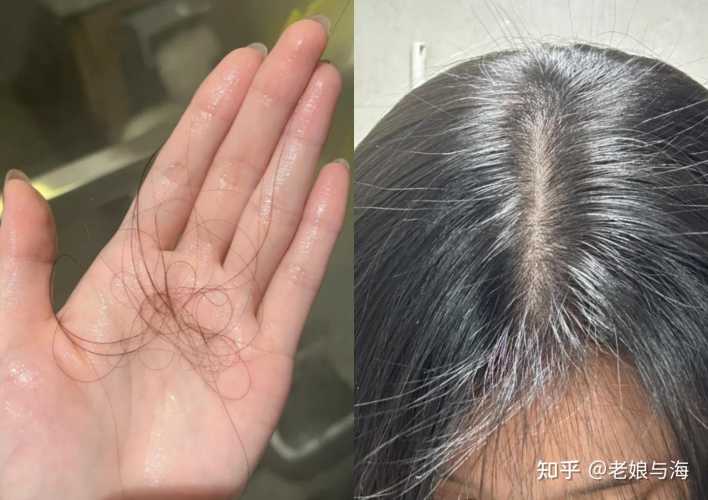 产后脱发还长白头发怎么办-第1张图片
