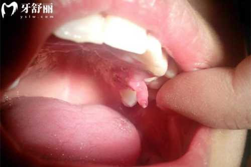 烂牙根会影响男孩备孕吗-第1张图片