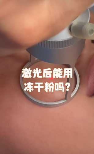 皮肤激光治疗影响备孕吗-第1张图片