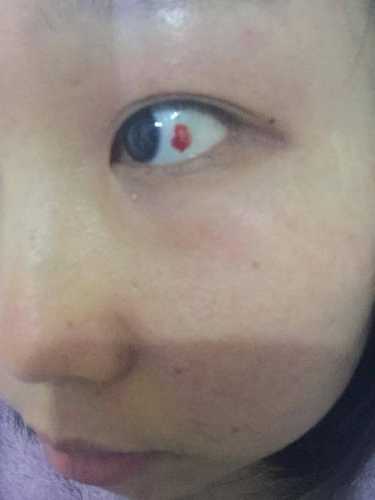 婴儿白眼球有红血块是怎么回事-第1张图片