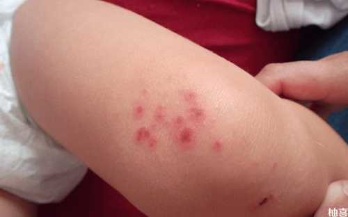 新生儿尿不湿过敏症状图片有哪些-第1张图片