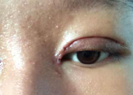 产后缝针出现息肉该咋办-第1张图片