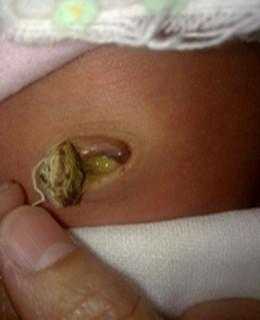 新生儿肚脐眼长啥样-第1张图片