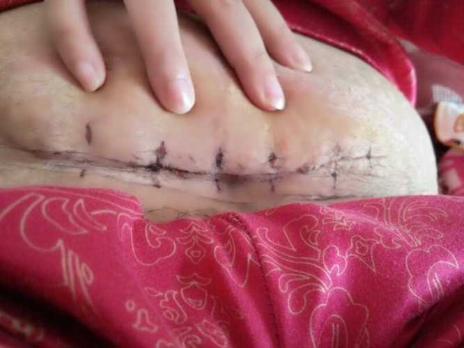 剖腹产后18天又流血了怎么办-第1张图片