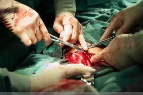 剖腹产用钛合金线有啥好处-第1张图片