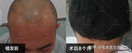 做植发后多久备孕合适-第1张图片