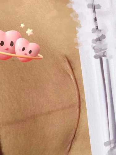 剖腹产术后需进氧仓吗-第1张图片