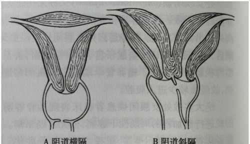 产后阴道前壁突出怎么办-第1张图片