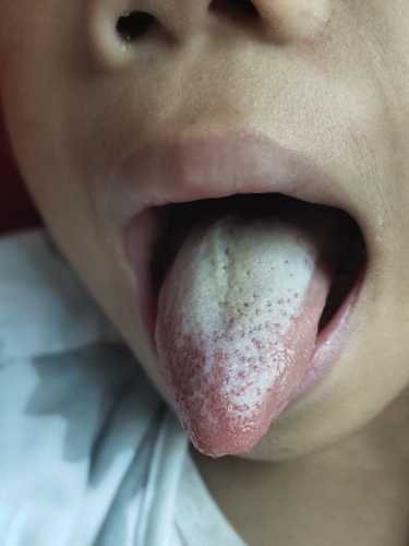 婴儿舌尖红是怎么回事-第1张图片