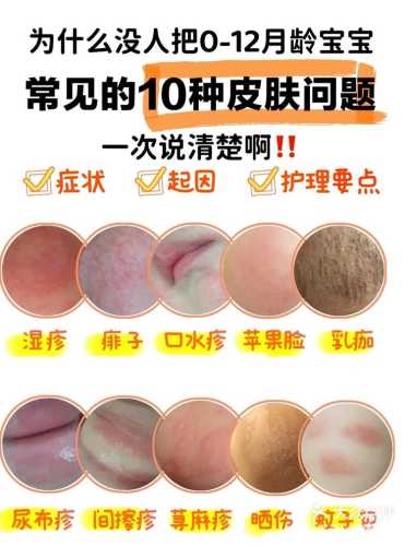 哪种尿不湿不会尿布疹-第1张图片