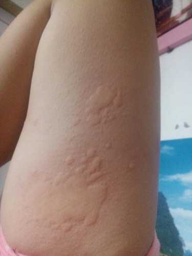 月子里过敏怎么办-第1张图片