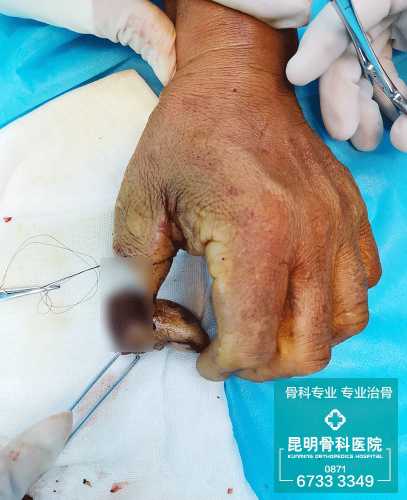 婴儿断指该如何紧急处理-第1张图片