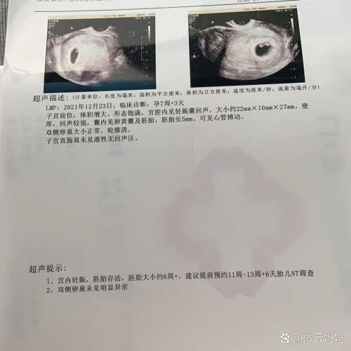 孕50天孕反突然没了正常吗-第1张图片