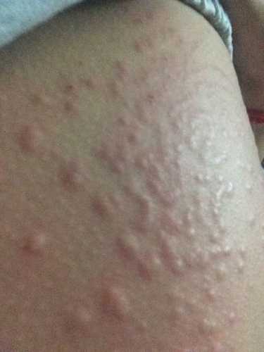 产后刺痒是怎么回事-第1张图片