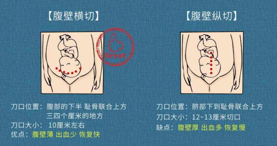 剖腹产刀口长度标准是多少-第1张图片